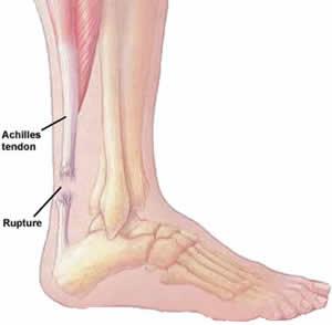 Achilles Tendon Rupture