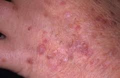 Actinic Keratosis