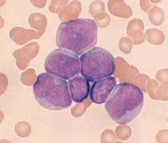 Acute Myelogenous Leukemia