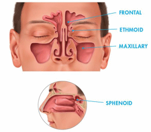 Nasal steroids acute sinusitis