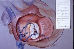 Arrhythmia & EP