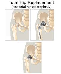 Arthroplasty