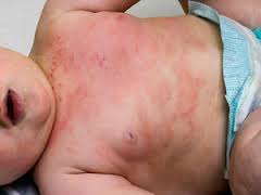 Atopic Dermatitis