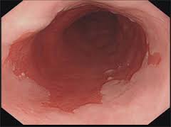 Barrett's Esophagus