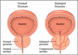 Benign Prostatic Hyperplasia