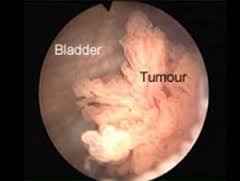 Bladder Cancer