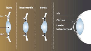 Cataract and Refractive Surgery