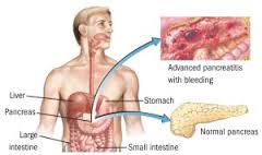 Pancreatitis