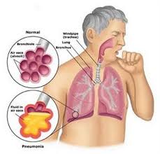 Pneumonia