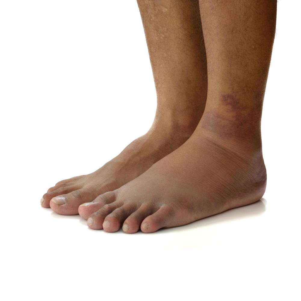 Reasons Why Your Feet Are Swollen