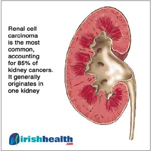 Renal Cell Carcinoma