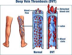 Thrombosis