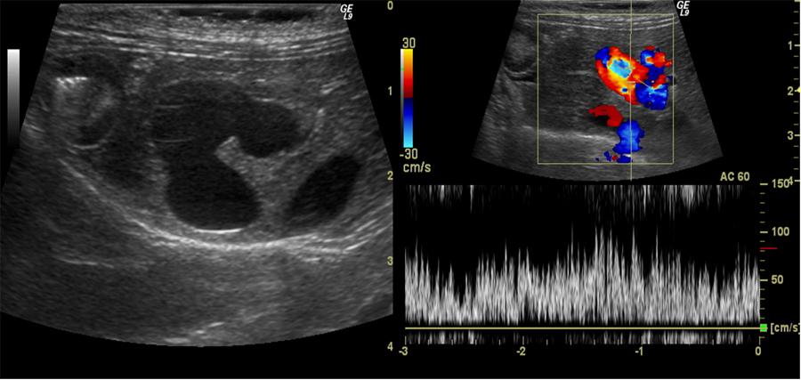 Effect of various B-mode controls to optimize the ultrasound images
