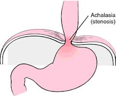 Achalasia