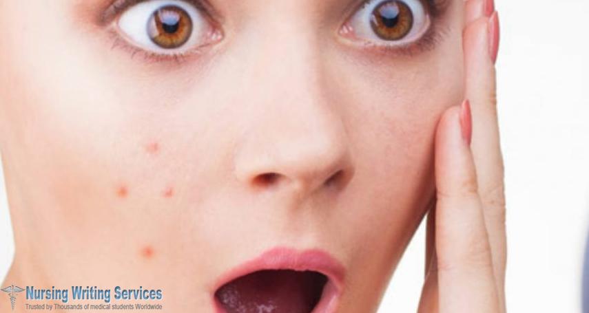 Home  Remedies  to  Get  Rid  of  Acne  Overnight