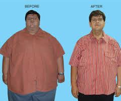 Bariatric Surgery