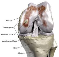 Osteoarthritis 