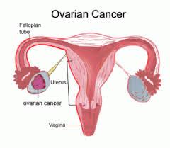 Ovarian  Cancer