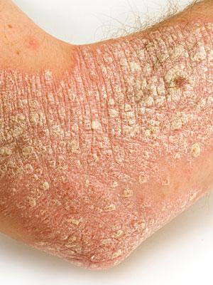 Psoriasis